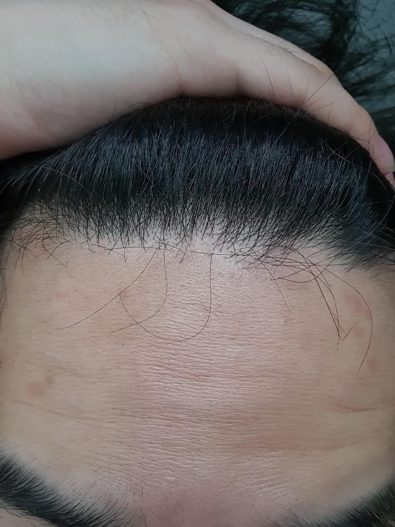 피나스테리드 5개월 후기