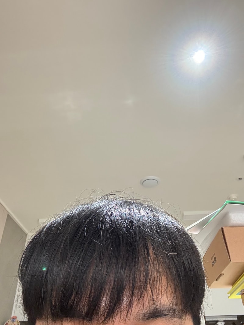 탈모인가요