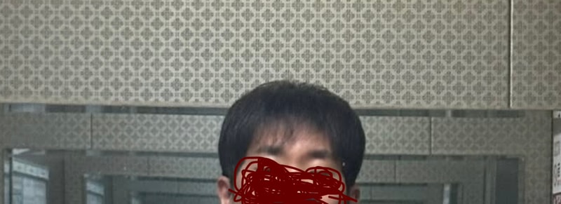 앞머리 탈모
