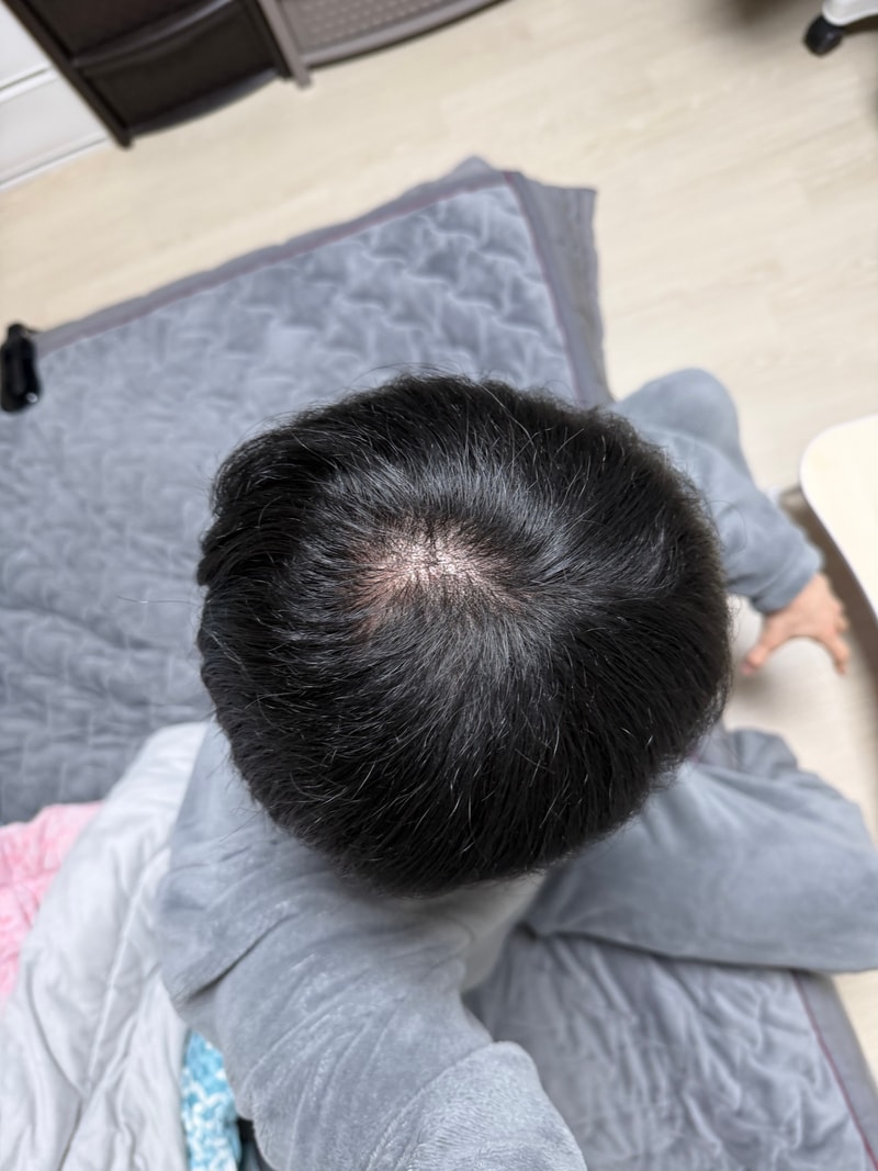 정수리 어떤가요 진단좀 부탁드려요