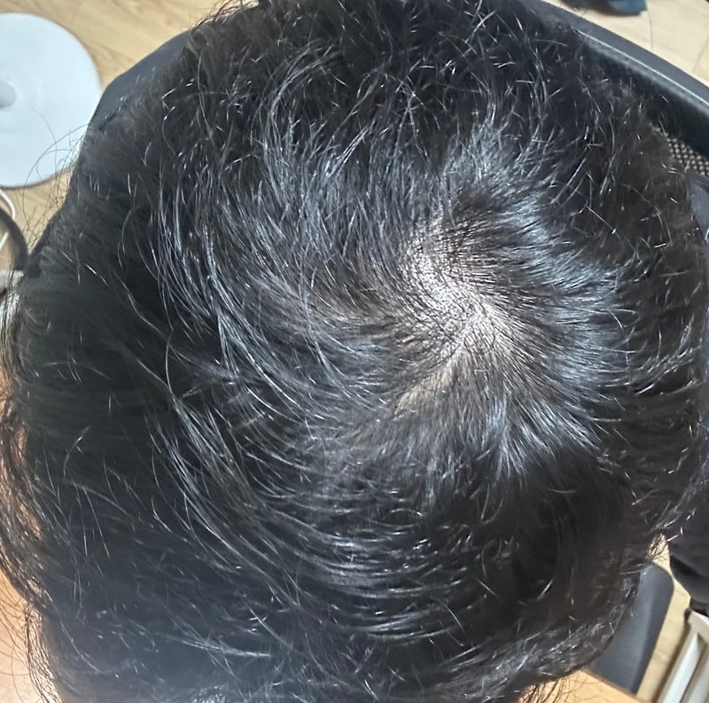 탈모인가요? 만약 맞다면 어떤 약 먹어야할까요?