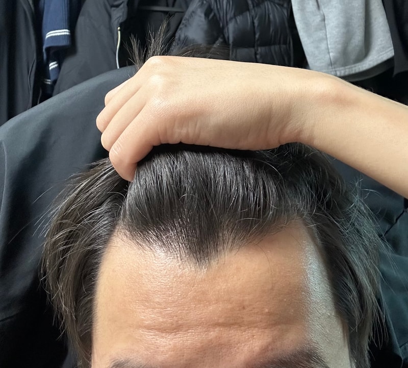 탈모 초기인가요?