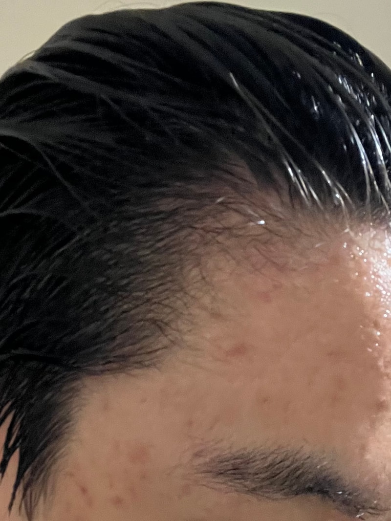 탈모인가요?