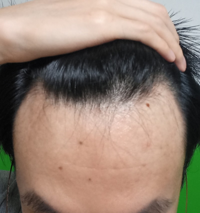 탈모 더 심해진거 같나요?