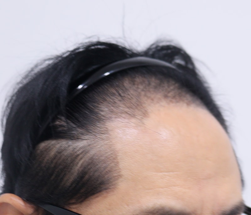 1. 수술전_3.JPG