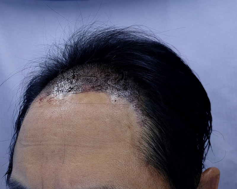 2. 수술후_1일_2.jpg