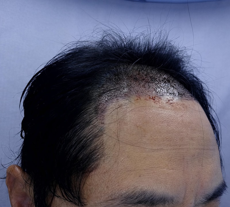 2. 수술후_1일_3.jpg