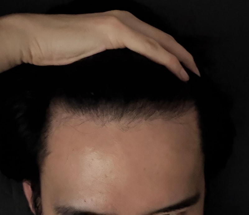 탈모 진행? 