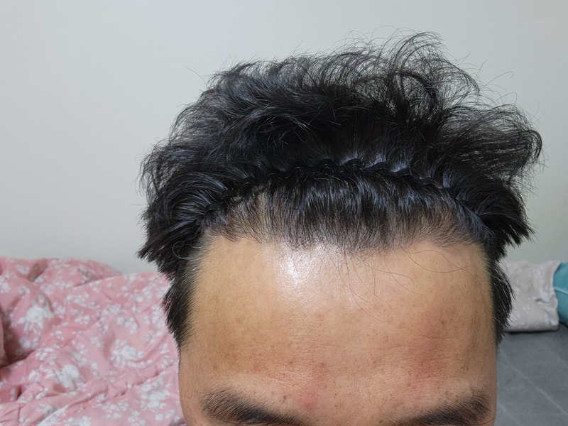 모발이식하고 8개월차 경과 좋네요