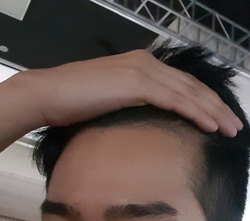 탈모약 복용 거진 2년