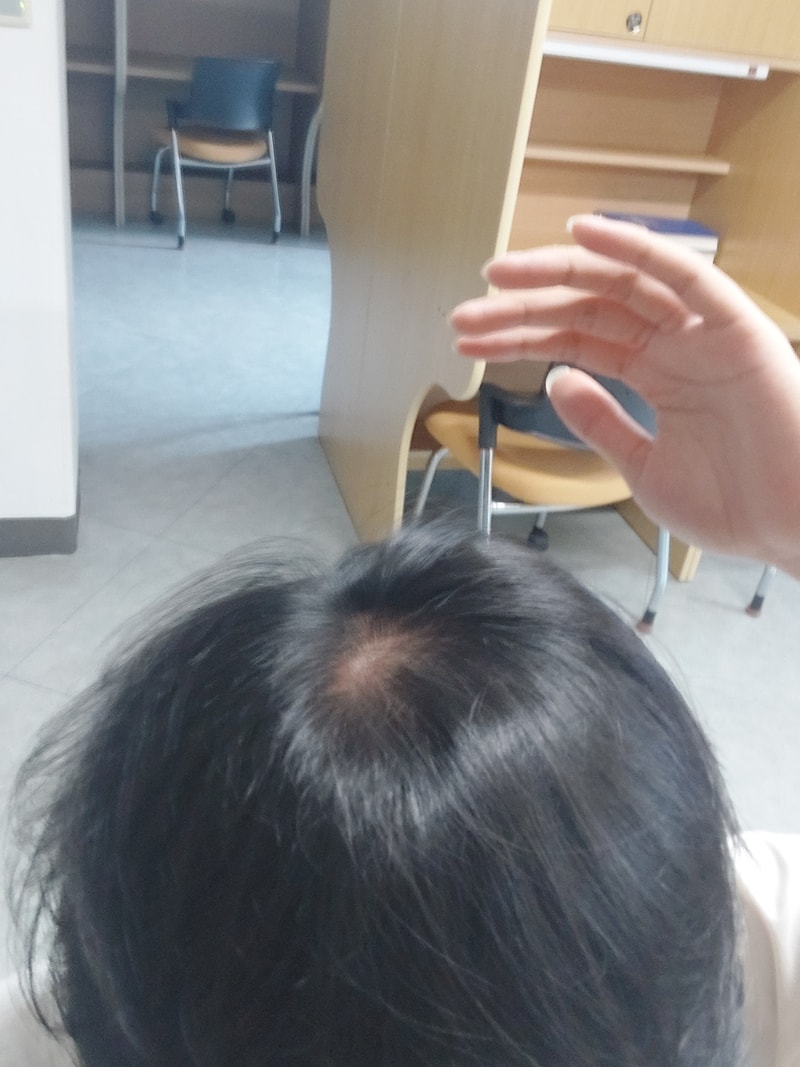 탈모인지 알려주세요