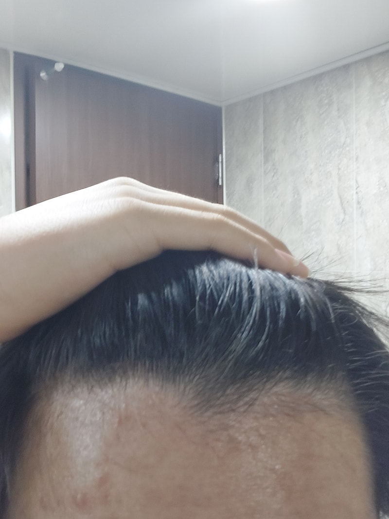 M자 탈모인가요?
