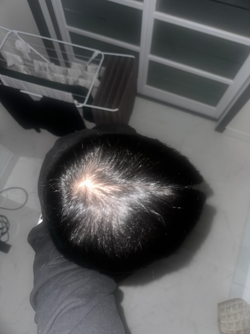 35세 남자입니다 탈모인가요?