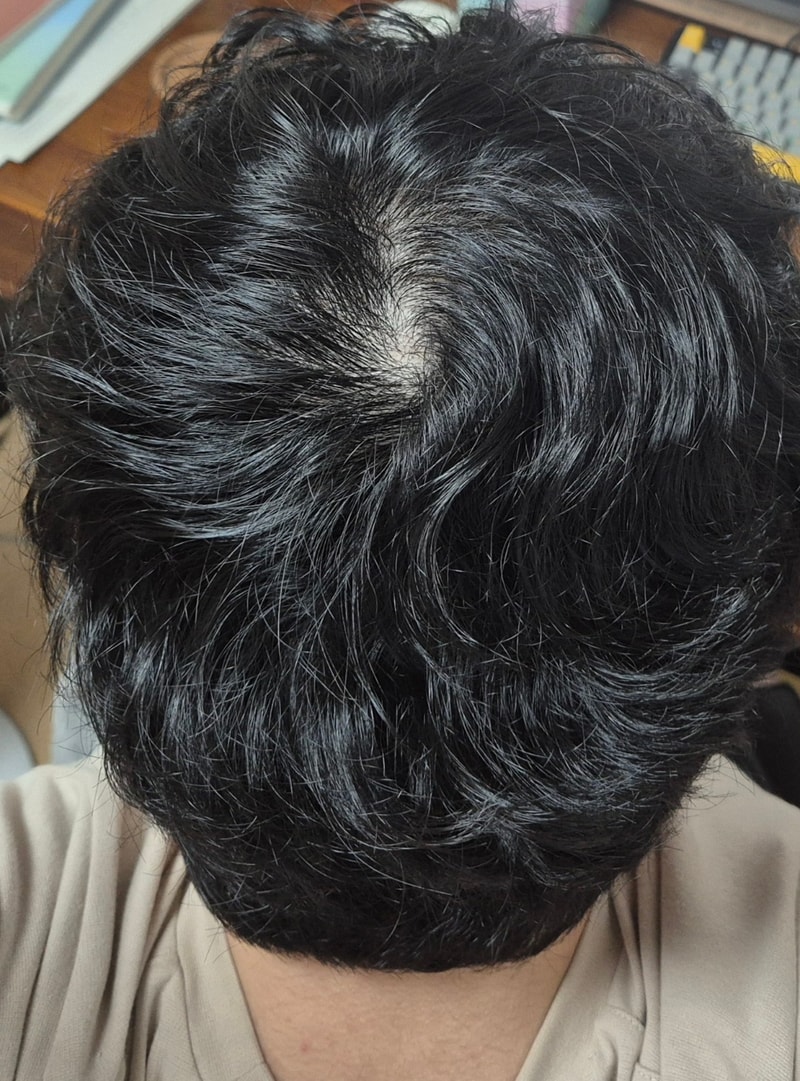 이정도면 탈모 중기는 넘었을까요..? 판단 부탁드려요