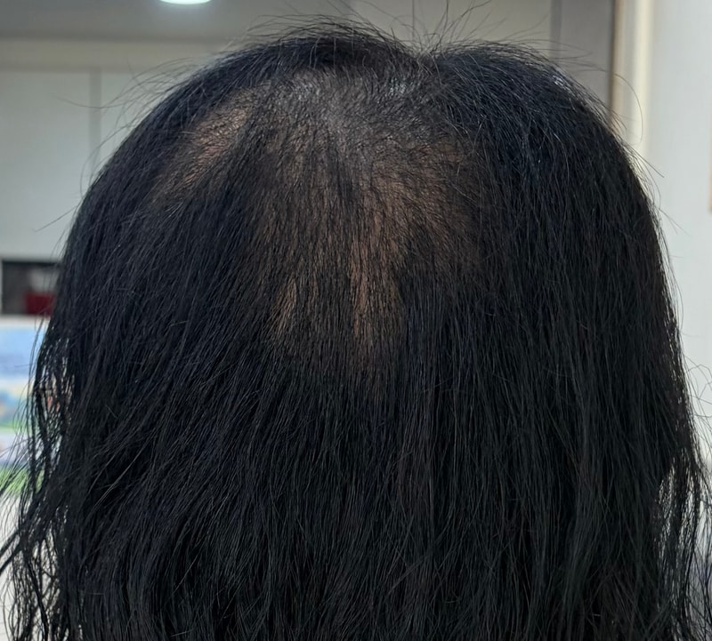 여성 탈모
