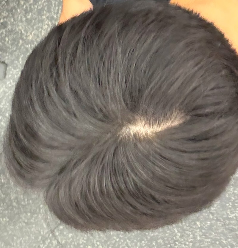 탈모 봐주십시요..