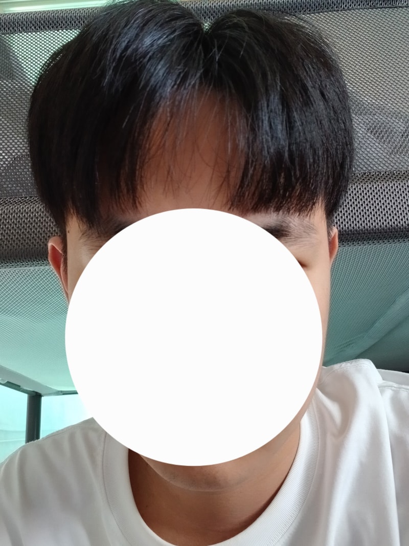 이마가 선천적으로 넓은데 탈모인지 헷갈려요..