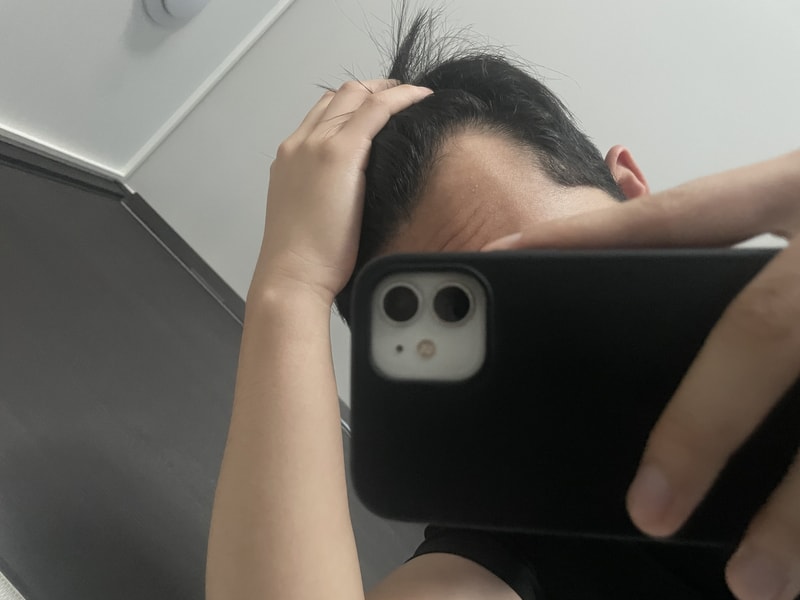 m자 심해지는 것 같아서 미녹시딜 바를까요