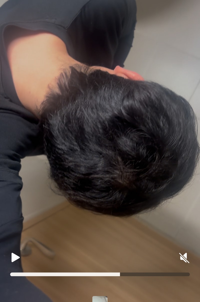 남자 탈모 진행 어느정도일까요??