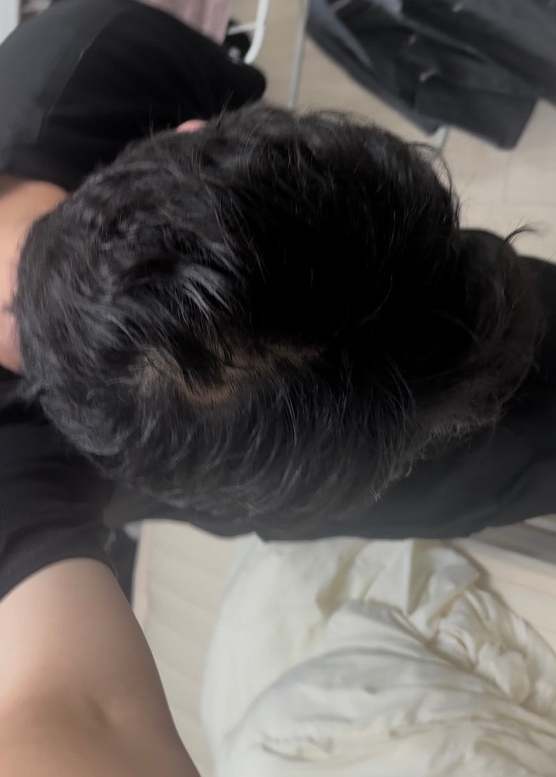 피나 격일로바꾼지 좀됐는데 정수리상태 어떤거같나요