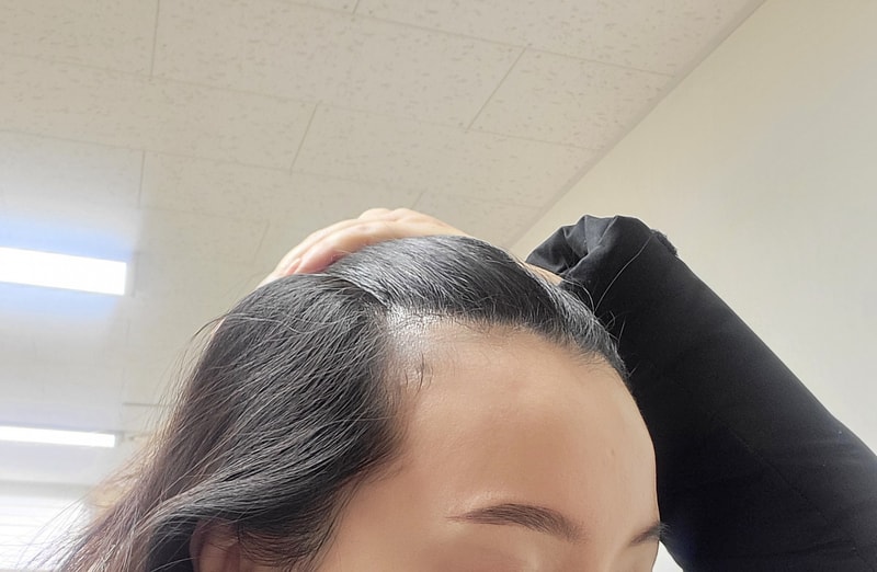 여자 m자이마 이정도면 심한편일까요?