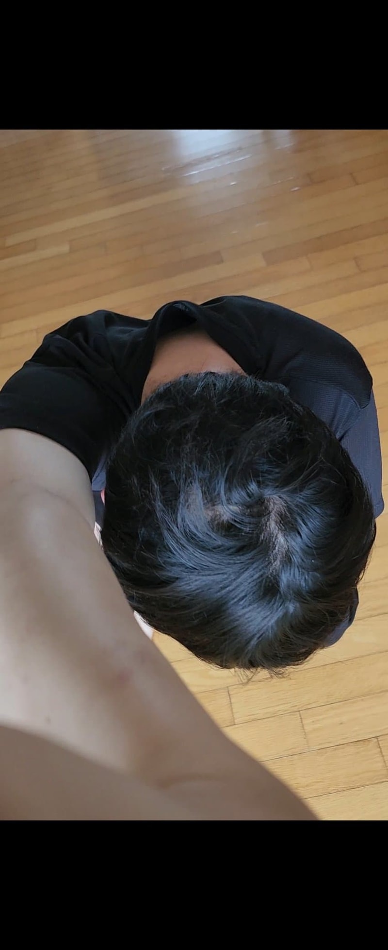 alopecia-20231219-084508-000-resize.jpg