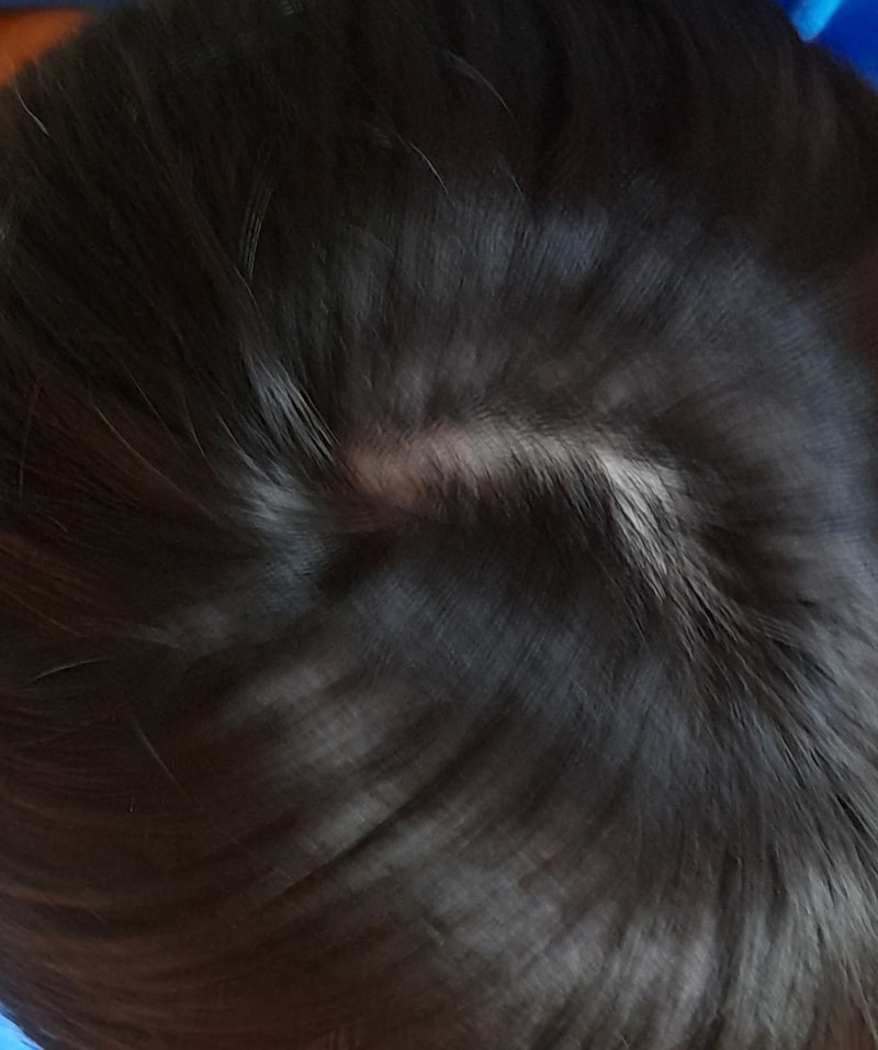 alopecia-20211101-152010-003.jpg