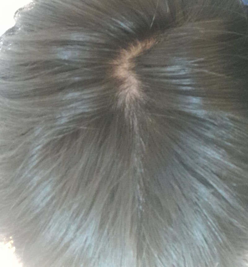 alopecia-20211101-152010-001.jpg