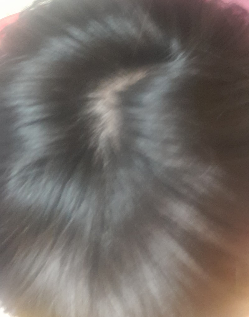 alopecia-20211101-152010-000.jpg