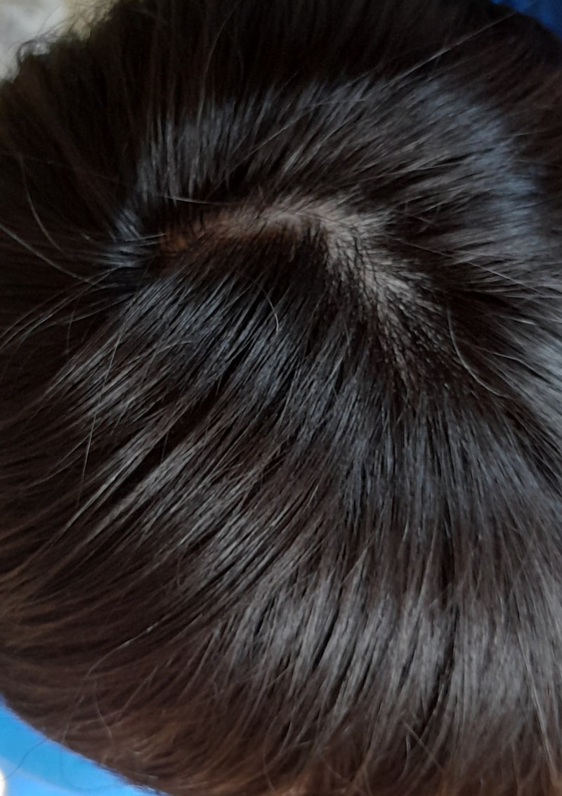 alopecia-20211101-152010-002.jpg