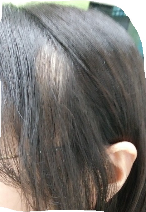 원형탈모.jpg