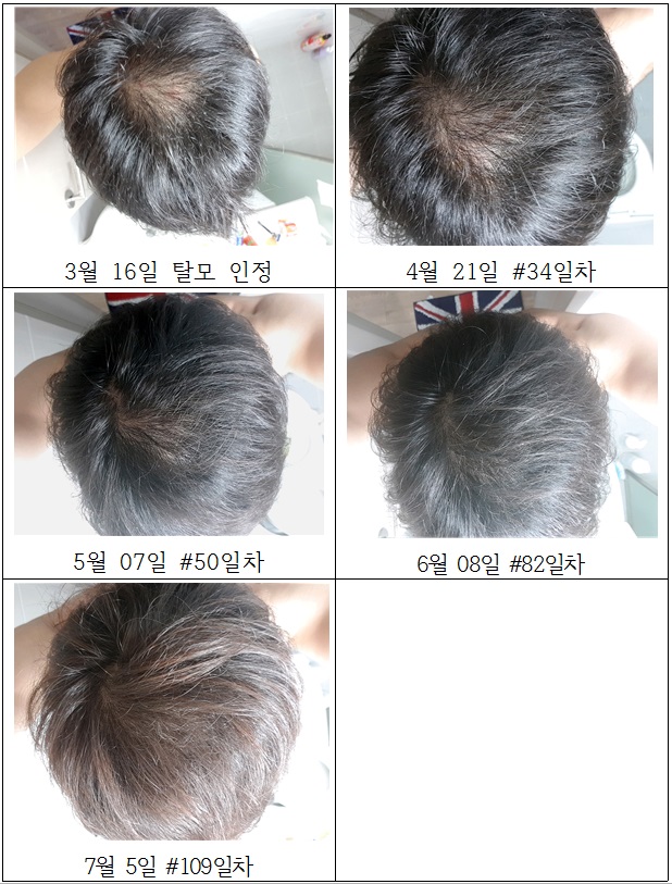 탈모.jpg
