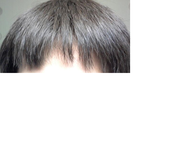 탈모1.png