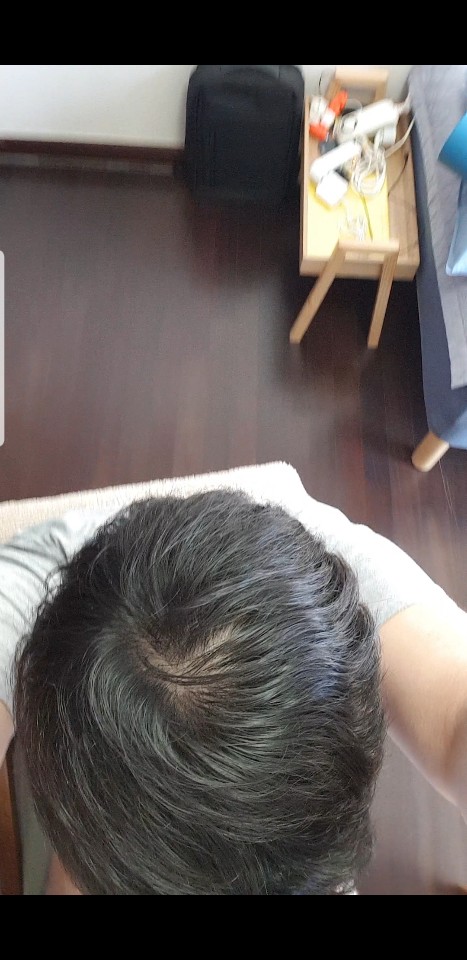 탈모 1.jpg
