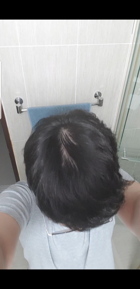 탈모 씨발탱.jpg