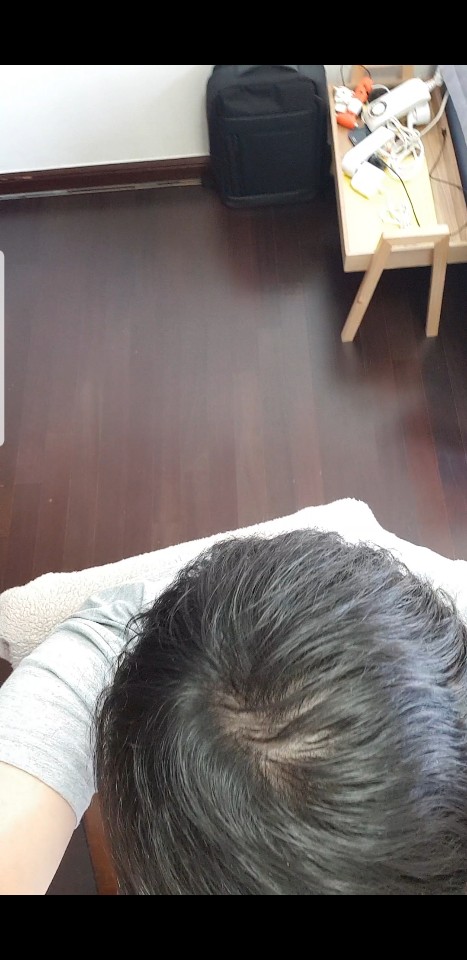 탈모2.jpg