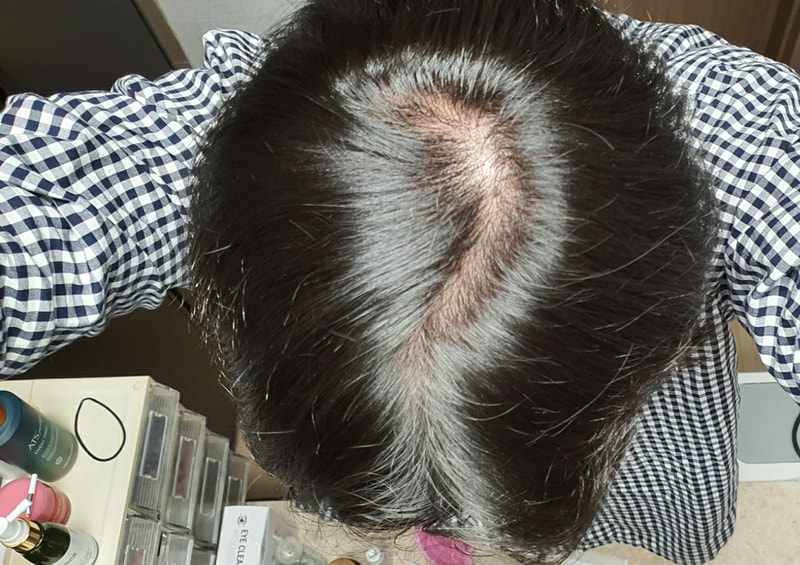 정수리.jpg