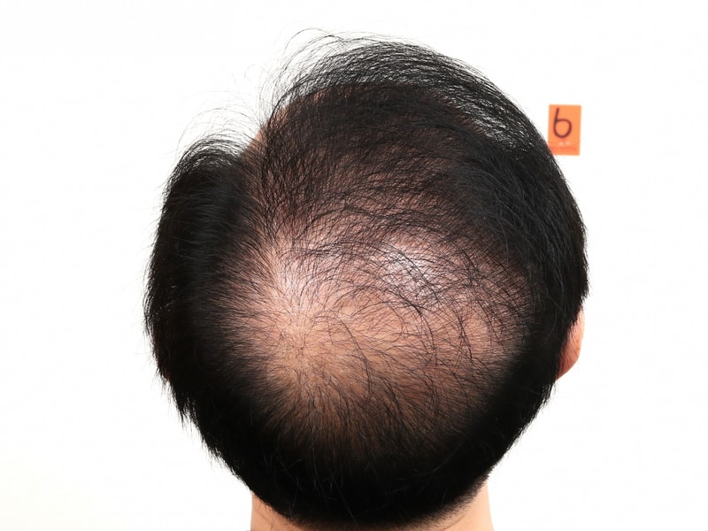 가망이 없어보이던 제 정수리 부산 맘모스에서 줄기세포 치료 받고 희망을 찾았습니다