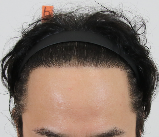 수술후.png