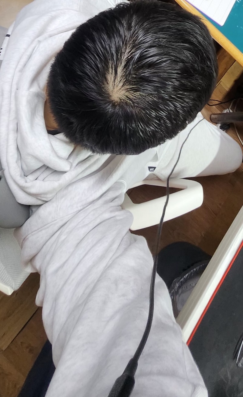 탈모일까요??