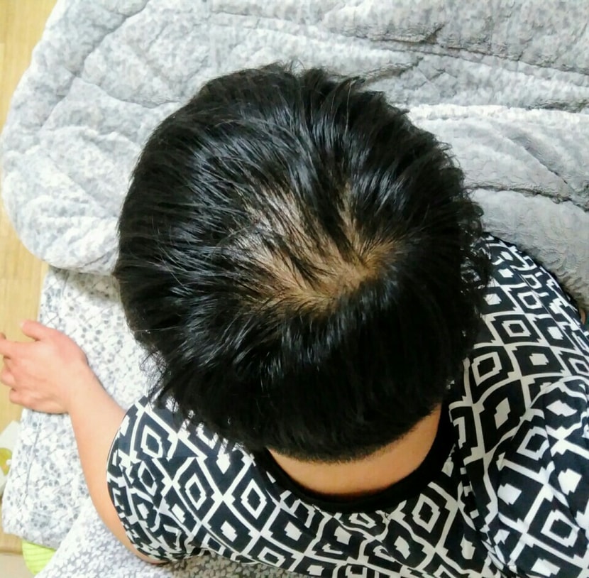 2달전 미녹시딜바른후 떡찐 정수리사진....