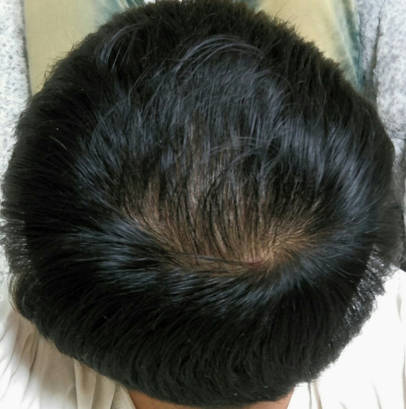 오늘 찍은 미녹시딜바른후 빗질한 정수리사진...