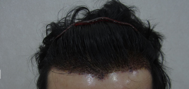 수술 사진2.png