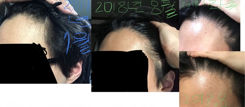 이마 좌측.jpg