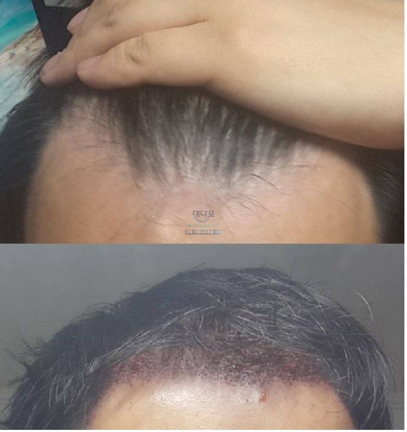 이식전.jpg