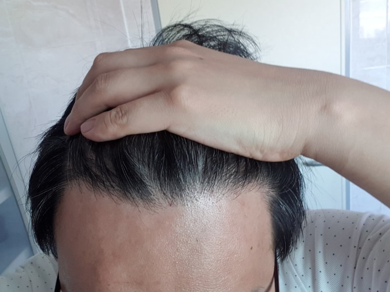 이식후.jpg