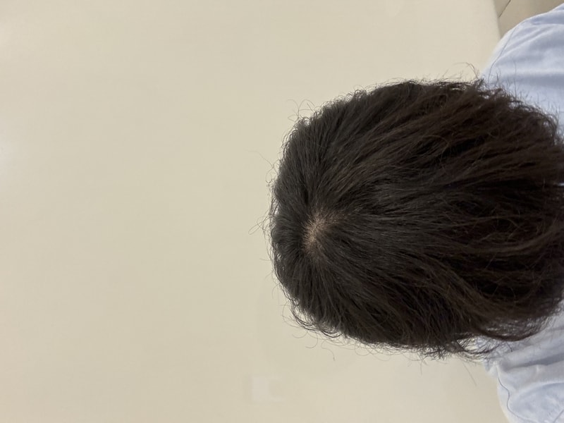 M자 정수리 탈모일까요?..