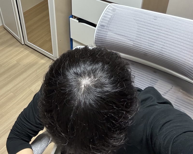 탈모 맞을까요?ㅠㅠ