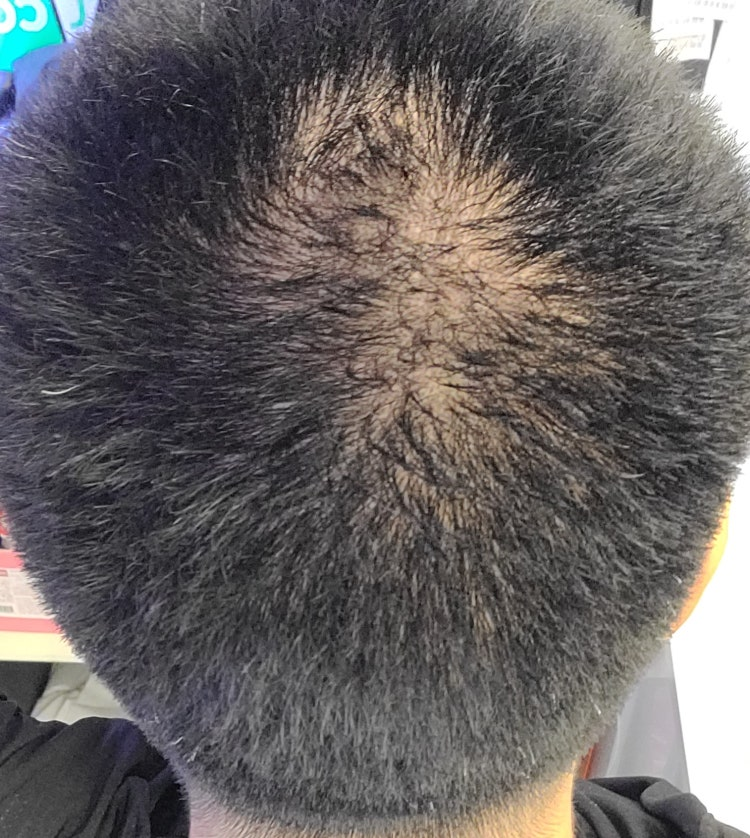 혹시 인천에 두피염이랑 탈모 같이 봐주시는곳 어디 없을까요??