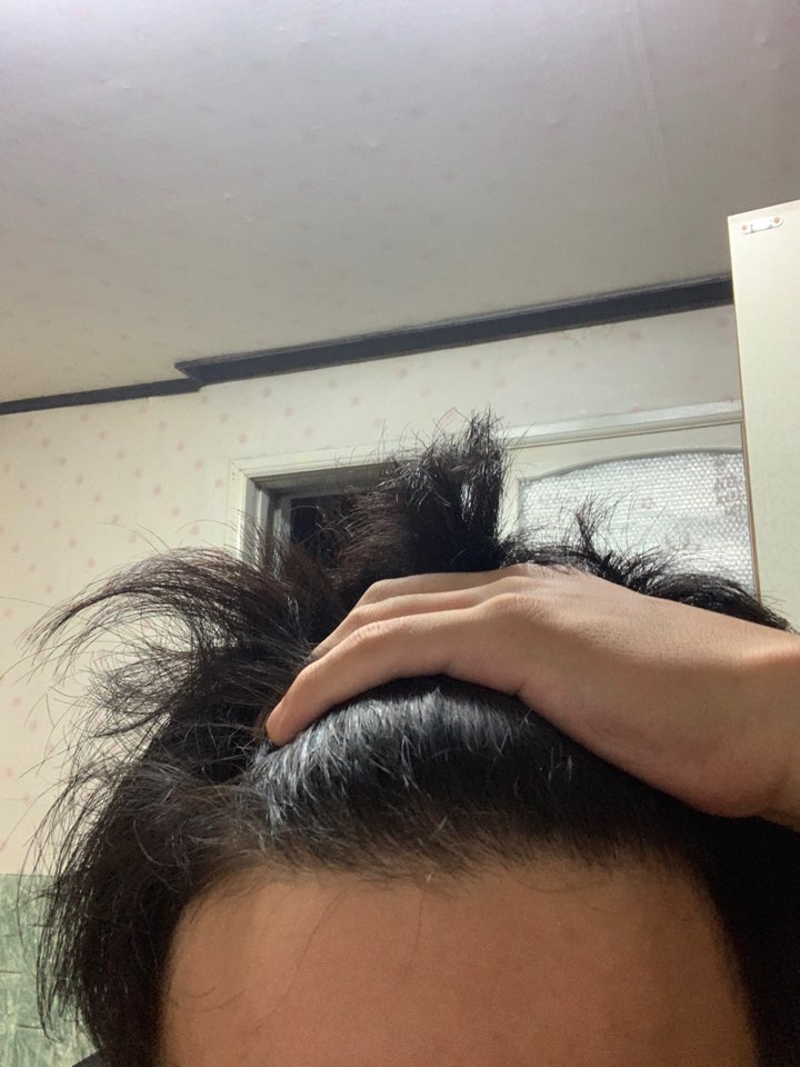 탈모의심사진.jpg